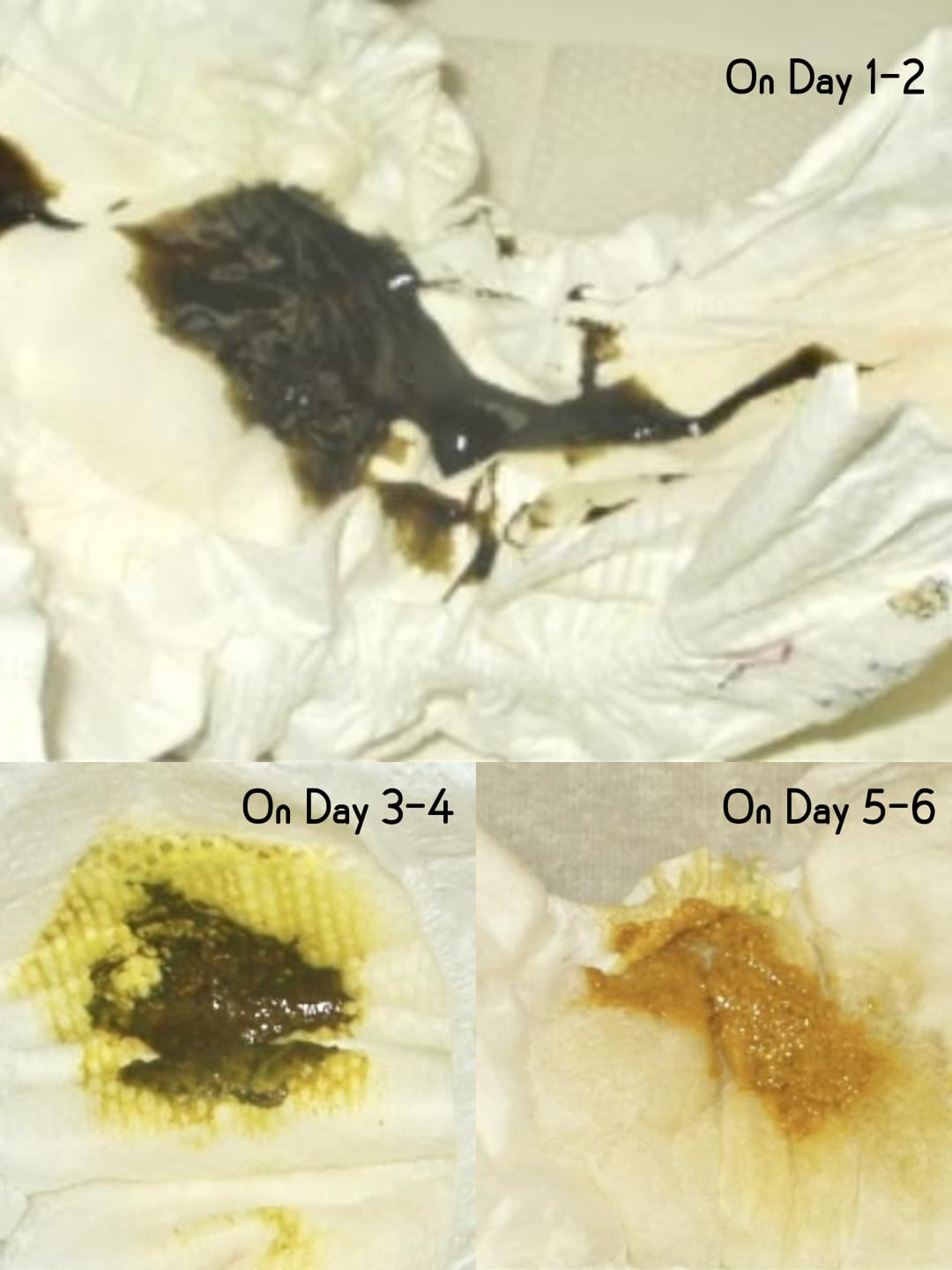 Understanding Your Newborn Baby’s Urine and Stool Patterns